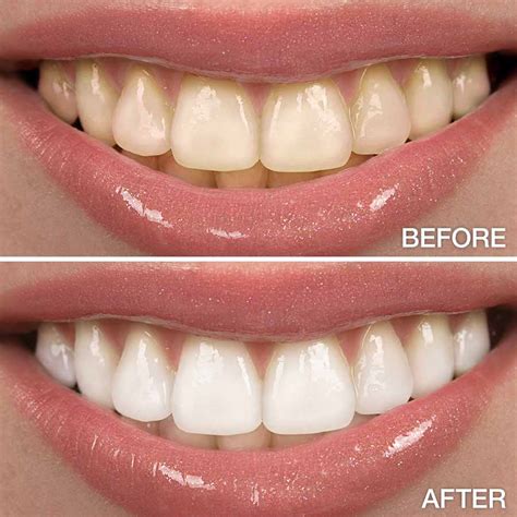 Magic white teeth whiening